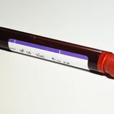 Experimental Blood Test Detects Cancer up to Four Years before Symptoms Appear