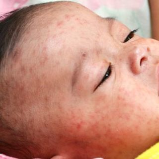 Measles cases hit record high in Europe