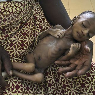 Virus-linked hunger tied to 10,000 child deaths each month