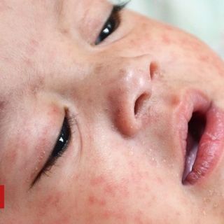 Measles outbreak declared in Philippines