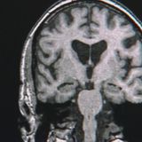 New drug shows potential for reversing memory loss