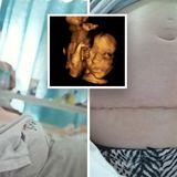 Unborn baby removed from mum's womb for surgery and then put back