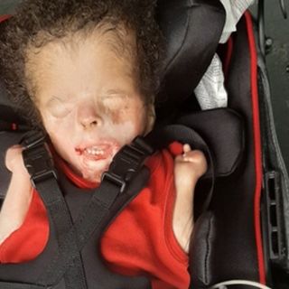 San Antonio's Baby Ja'bari is healing well after lab-grown skin grafts