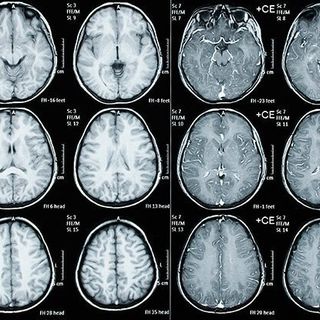 Groundbreaking Study Reveals The Extent of Brain Abnormalities in American Children