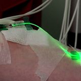 Intravenous Light Therapy Provides Relief for People With Lyme Disease