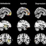 Profound loss of pleasure related to early-onset dementia