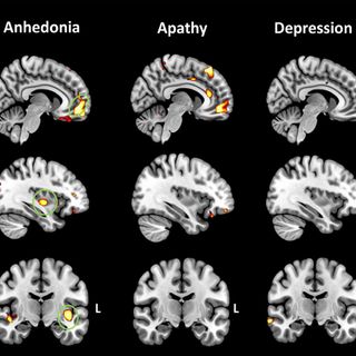 Profound loss of pleasure related to early-onset dementia