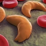Children to get CRISPR treatment for sickle cell disease in trial