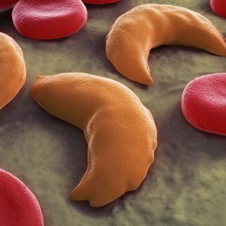 Children to get CRISPR treatment for sickle cell disease in trial