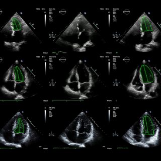 First-of-its-kind trial shows AI beat humans at analyzing heart scans