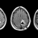 Treatment Breakthrough for an Intractable Brain Cancer