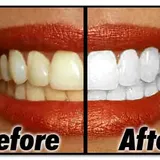 Teeth Whitening Products vs Professional Teeth Whitening From A Dentist: How Do They Compare In Terms Of Effectiveness?