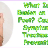 What Is a Bunion on Your Foot? Causes, Symptoms, Treatment, Prevention