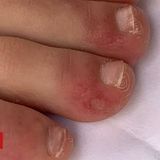 Coronavirus: 'Covid toe' and other rashes puzzle doctors