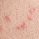 What do Flea Bites Look Like - Flea Bite Pictures