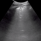 #POCUS for #COVID19 What to look for when risk statifying patients with suspected or confirmed illness #Lung #Pulmonary #foamed #foamus