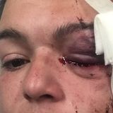 Journalist blinded by rubber bullet during protest sues Minneapolis police, State Patrol