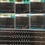 First known case of a potentially deadly heart rhythm disturbance induced by chloroquine therapy for COVID-19 reported