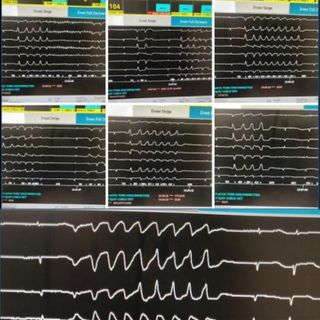 First known case of a potentially deadly heart rhythm disturbance induced by chloroquine therapy for COVID-19 reported