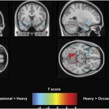 Long-Term Effects of Cannabis on Brain Structure - Neuropsychopharmacology