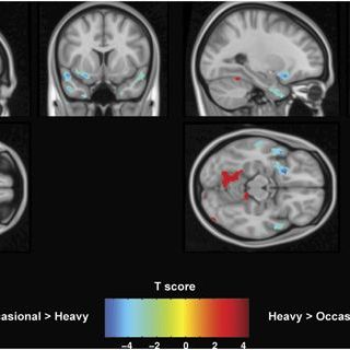 Long-Term Effects of Cannabis on Brain Structure - Neuropsychopharmacology