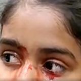 11-year-old girl cries blood for a week, baffling doctors