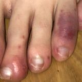 New study finds evidence between COVID-19 and 'COVID toes' symptom